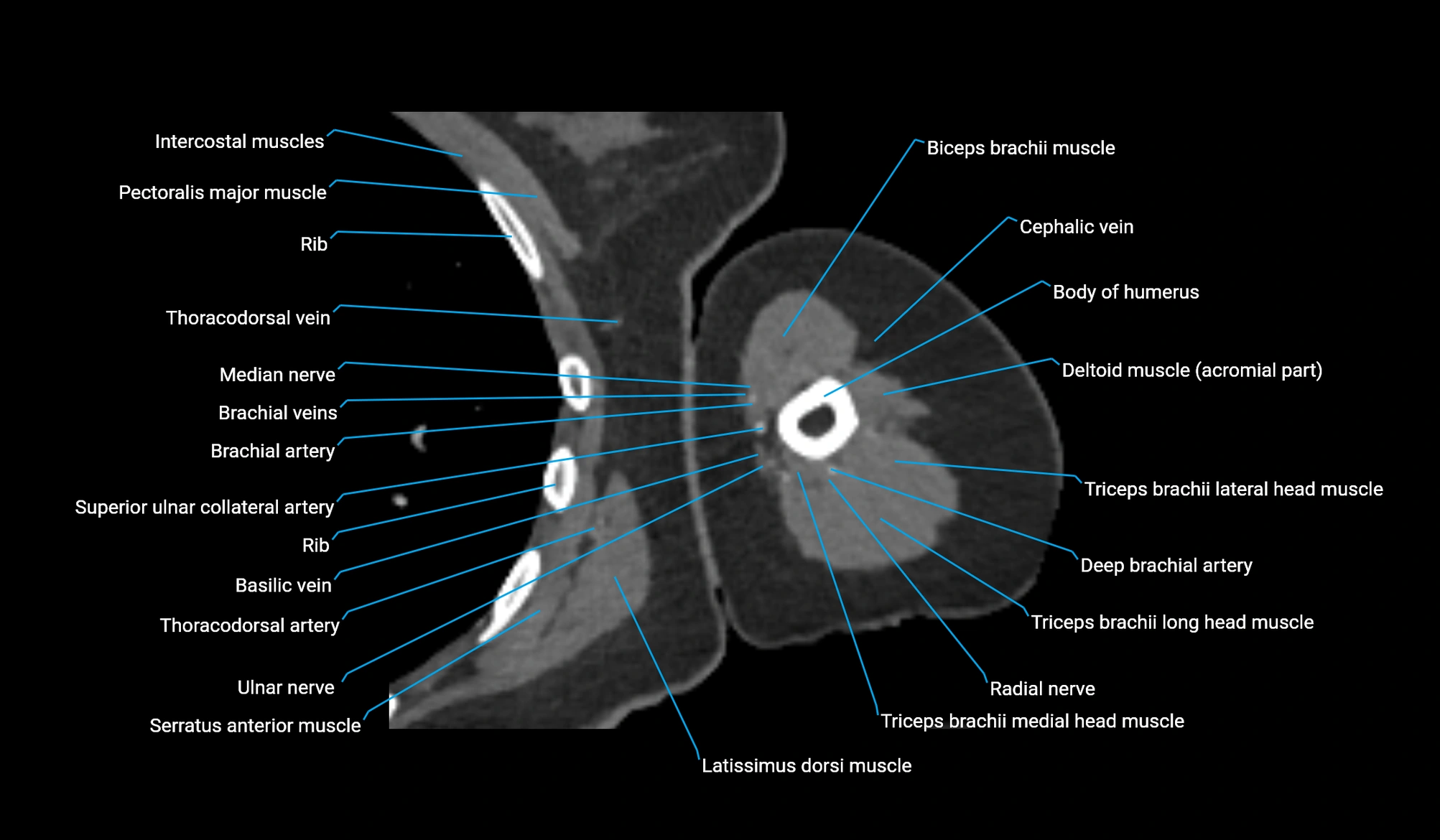 CT upper arm axial  cross sectional anatomy labelled radiology image -00210.webp
